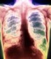 Туберкулёз наступает на Запорожье
